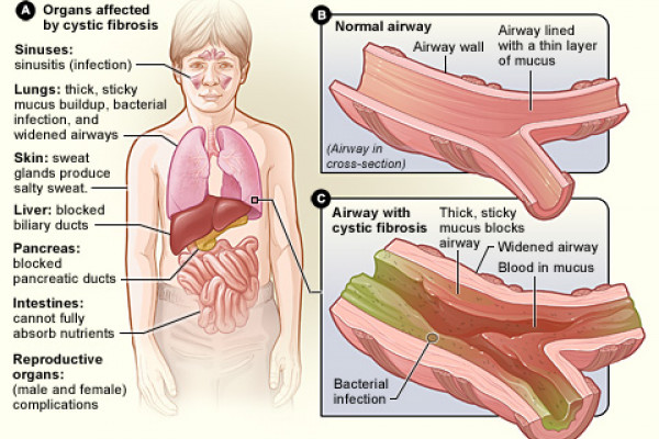the organs that cystic fibrosis can affect. Figure B shows a cross-section of a normal airway. Figure C shows an airway with cystic fibrosis. The widened airway is blocked by thick, sticky mucus that contains blood and bacteria.