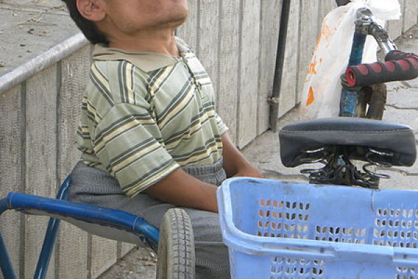 A man with achondroplasia, also known as dwarfism.