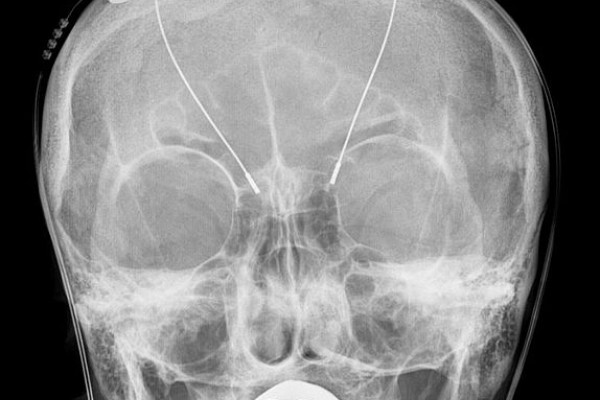 Deep brain stimulation - probes shown in X-ray of the skull (white areas around maxilla and mandible represent metal dentures and are unrelated to DBS devices)