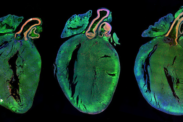  Neonatal rat hearts treated with a control microRNA (left) or two human microRNAs strongly increasing cardiomyocyte proliferation (middle and right). The picture shows the presence of several, replicating (red) cells in the muscular mass of the left...