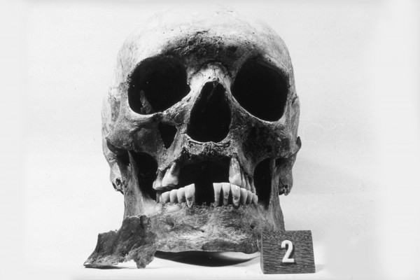 Skull showing loss of front teeth, widening of the nose opening, and loss of bone in upper jaw underneath nose - Excavated from the 12th-16th century AD leprosy hospital cemetery at Naestved, Denmark