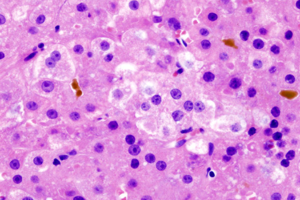 Histopatholgical image of hepatocellular carcinoma in a patient with liver cirrhosis by chronic hepatitis C infection. Hematoxylin and eosin stain.