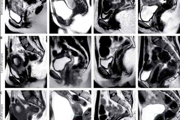 MRI scans of patients implanted with vaginas grown in-vitro.