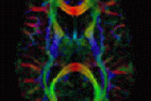 Diffusion Tensor Imaging (DTI) image