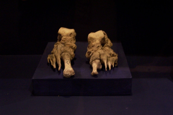 Bones from the feet of a leper, clearly deformed by the illness. Museum Ribes Vikinger, Ribe, Denmark, May 2005