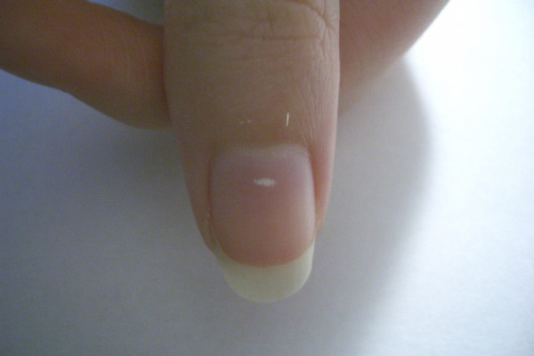 What Causes Fingernails to Split Down the Middle: A Comprehensive  Examination of the Causes - PharmEasy Blog