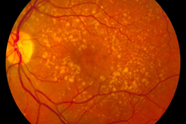 A fundus photo showing intermediate age-related macular degeneration.