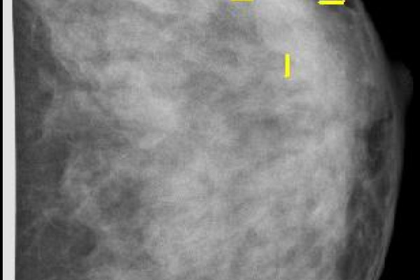 Mammogram showing breast cancer