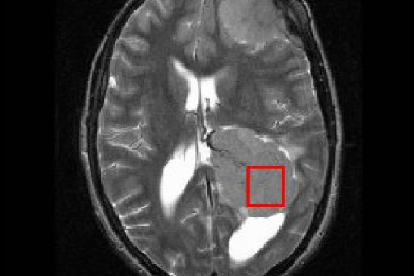 MRI brain scan used as MRS localiser