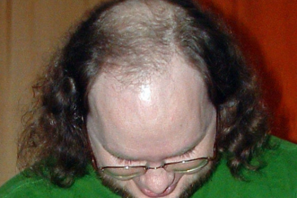 Male Pattern Baldness