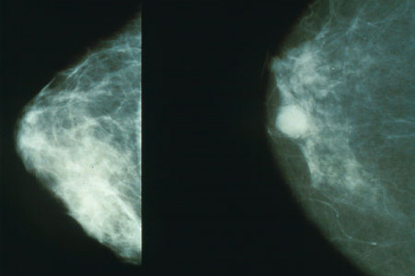 Normal (left) versus cancerous (right) mammography image.