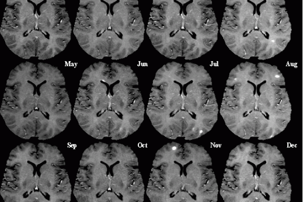 Multiple Sclerosis: T1-weighted MRI (post-contrast) of same brain slice at monthly intervals. Bright spots within the brain tissue indicate active lesions.