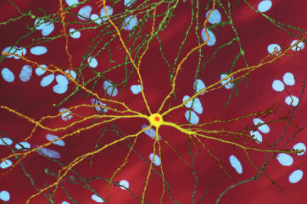 Single striatal neurons (yellow) transfected with nuclear inclusion (orange) mHtt, other neurons in background (blue).