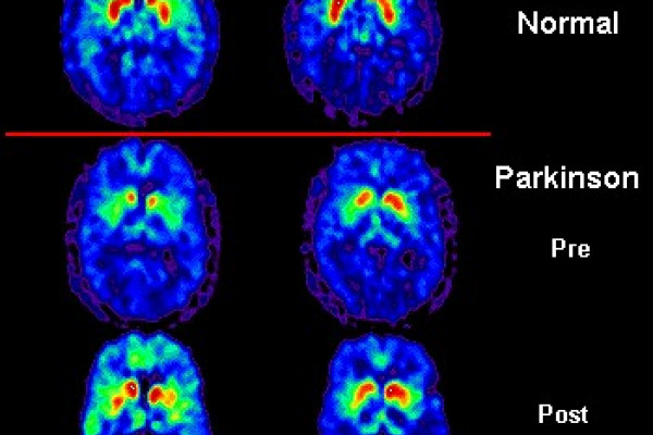 PET scan of Parkinson's patient