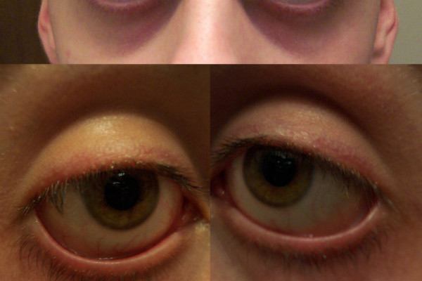  These photographs (all taken at the same time, of the same 19 year old, caucasian male) serve as examples of periorbital darkness, periorbital puffiness, pronounced vein visibility, and shadowing due to sunken eye sockets. It should also be noted...
