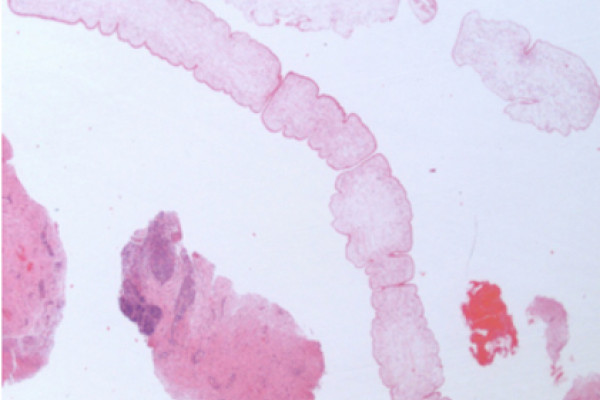 Unsegmented ribbon of worm next to fragments of inflamed brain