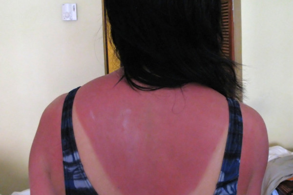 Sun Burn