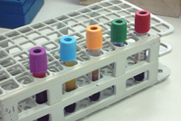 A range of vacutainer tubes containing blood samples