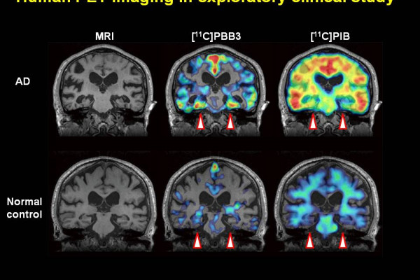 Alzheimer's brain