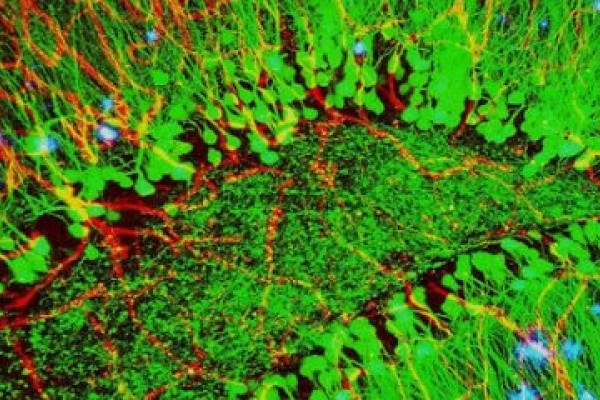 An image of a mouse brain showing symptoms of Alzheimer's disease; plaques of protein (blue) among blood vessels (red) and nerves (green). Researchers believe a nutritional drink may slow early development of the disease.