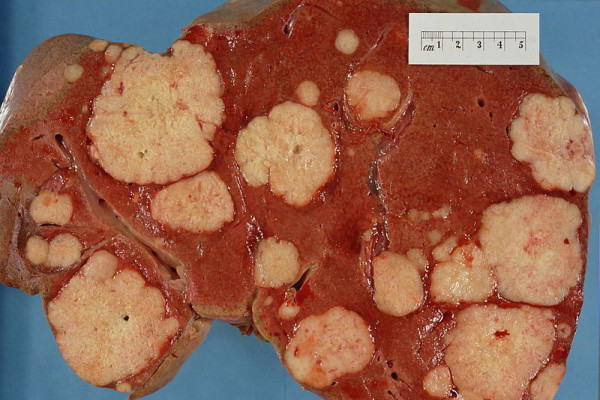 Cross section of a human liver, taken at autopsy examination, showing multiple large pale tumor deposits. The tumor is an adenocarcinoma derived from a primary lesion in the body of the pancreas.