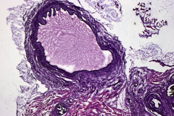 A mouse model of endometriosis, characterised by cyst formation