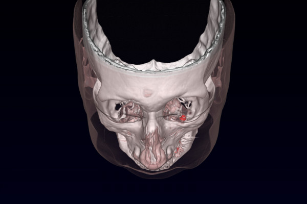 Magnetic prosthesis for nystagmus