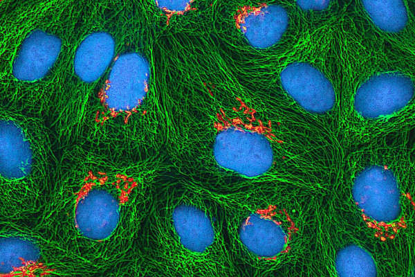 HeLa cells - collected originally from cancer patient Henrietta Lacks - growing in culture.