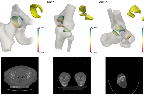 Osteoarthritis 3-D Image