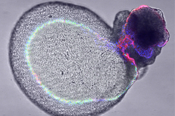 Polycystic kidney disease cultured organoid with a cyst