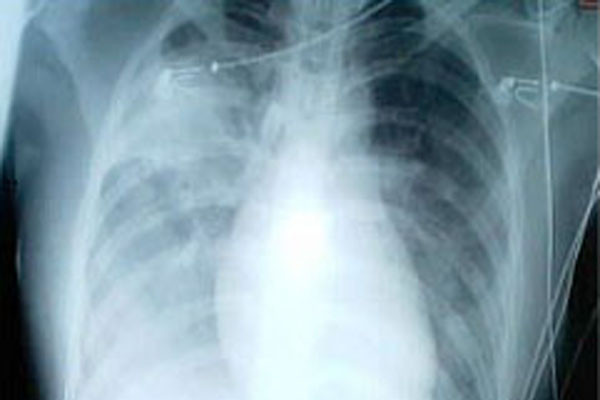 SARS X-ray appearance