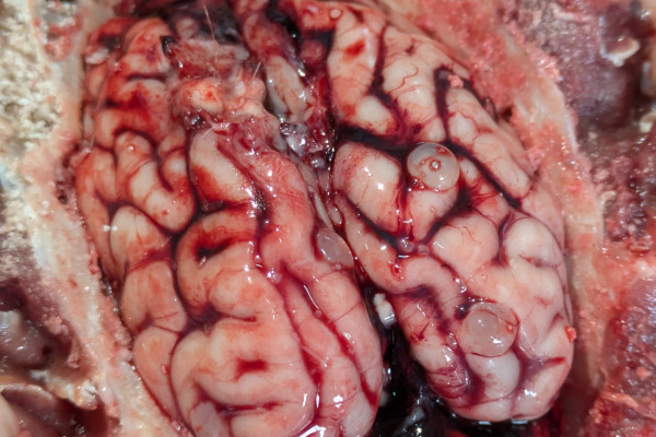 Cysicercosis: brain cysts caused by larvae of the pig tapeworm 