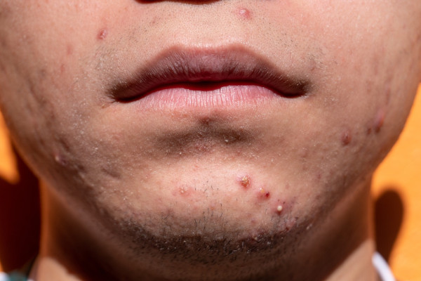 Acne - spots on a person's chin
