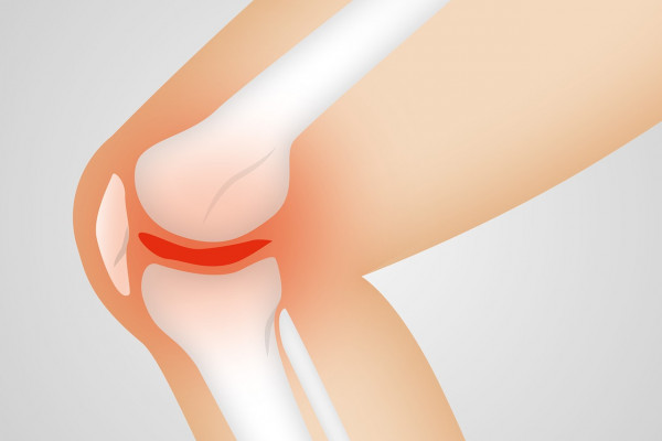 a cartoon of an osteoarthritic knee