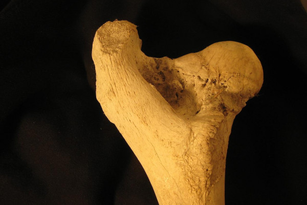 femur bone