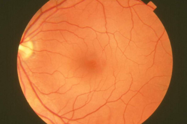 Fundus photograph-normal retina