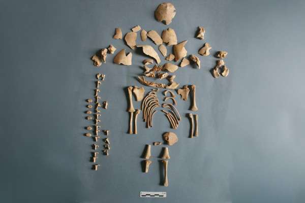 Down's syndrome skeletal remains