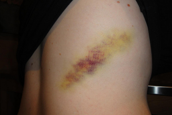 Yellow bruise on leg
