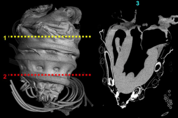 Robotic sleeve for heart failure