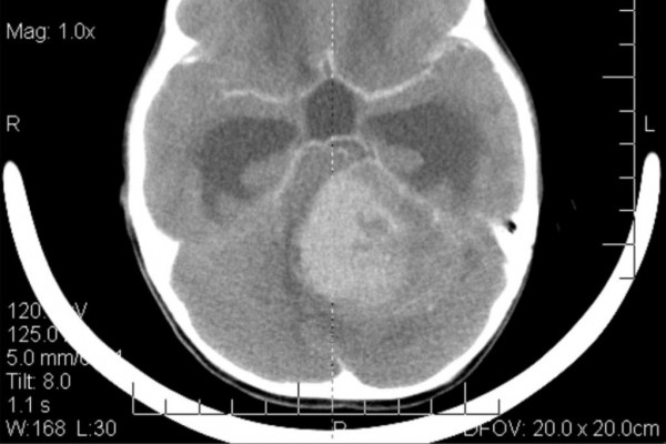 Medulloblastoma, paediatric brain scan