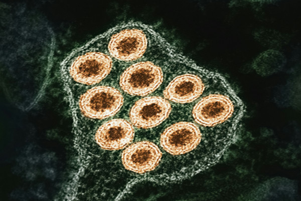 Measles virus