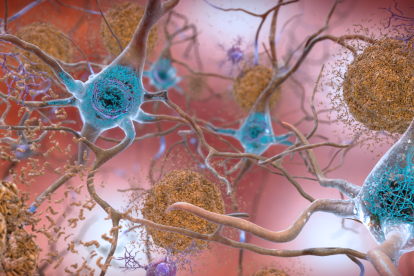 Cartoon of nerve cells (neurones) affected by Alzheimer's Disease with beta-amyloid plaques and neurofibrillary tangles