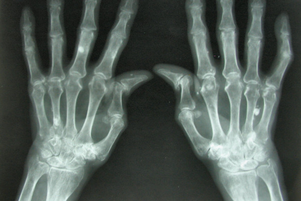 Arthritis breaks down the cartilage between joints, leading to pain, stiffness and swelling. 