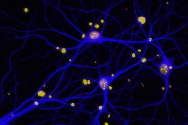 Dementia neuron