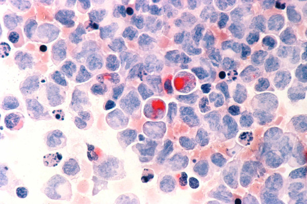 Early diagnosis of acute myelocytic leukemia (AML) paves the way for treatment.