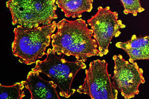 Melanoma tumour cells