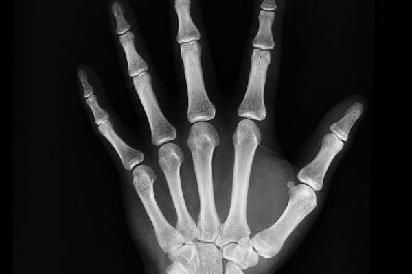 radiograph of hand