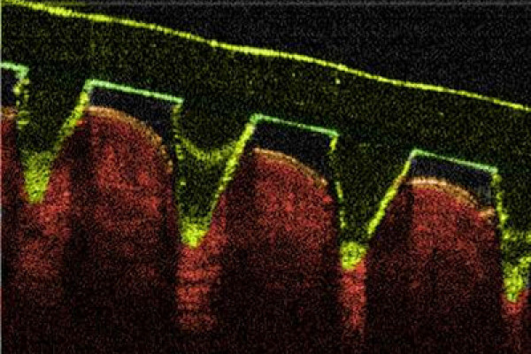 Microneedles pierce skin painlessly to deliver drugs and even remove blood samples for analysis.