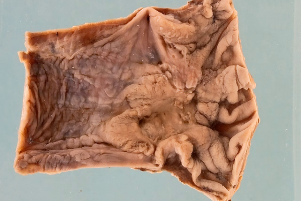 Adenocarcinoma of the oesophagus