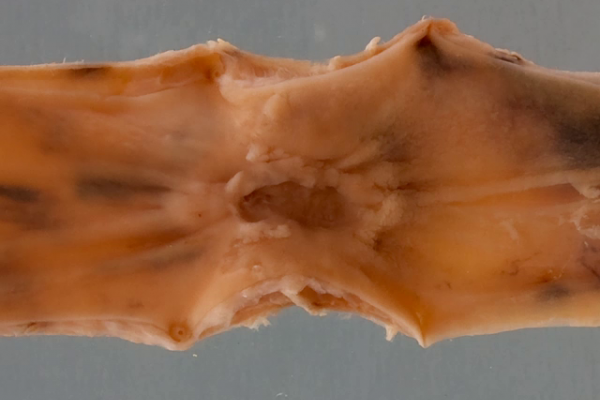Barrett's oesophagus with adenocarcinoma